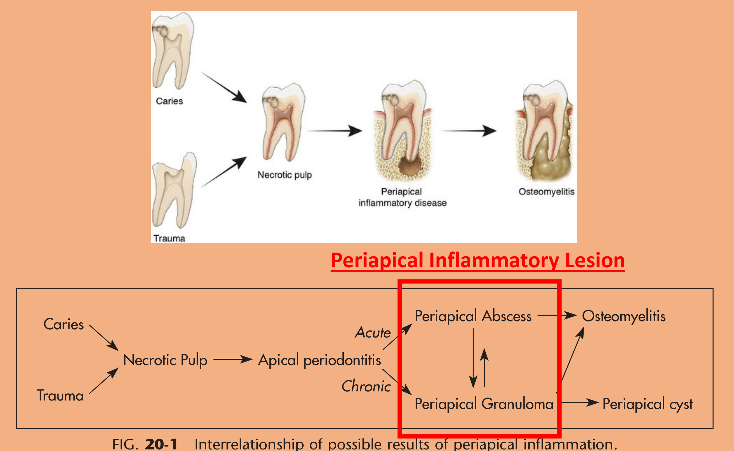 FIG. 20-1 Interrelationship of possible results of periapical inflammation.