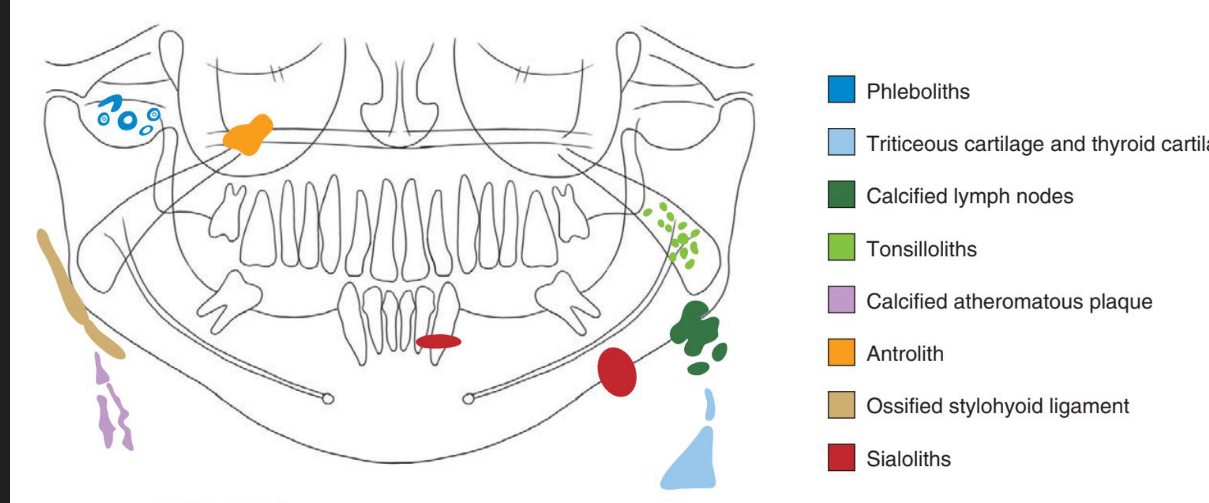 FIGURE 28-1 Schematic of panoramic radiograph demonstrating the typical geometry and location of selected soft tissue calcifications and ossifications.