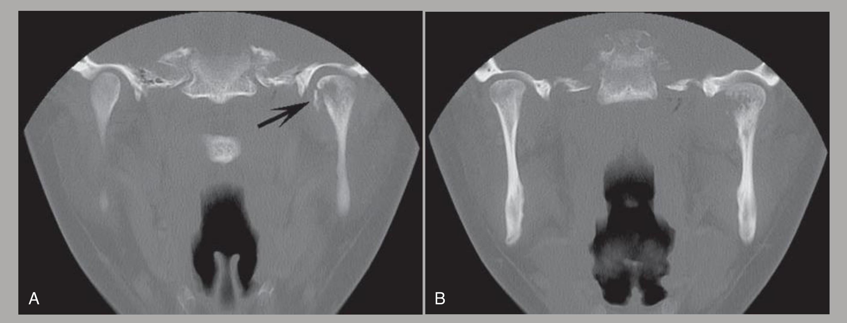 FIG. 23-12 A and B, Coronal CT images with bone algorithm demonstrating Ewing’s sarcoma involving the left mandibular condyle; note the irregular margins, destruction of the medial cortex of the condyle, and a small pathologic fracture (arrow).