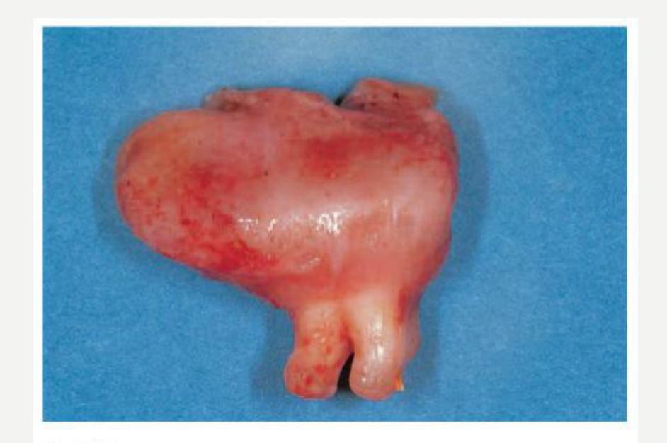 Fig. 7.15 Dentigerous cyst. This cyst has been removed together with its associated tooth. The cyst surrounds the crown and is attached at the cementoenamel junction.