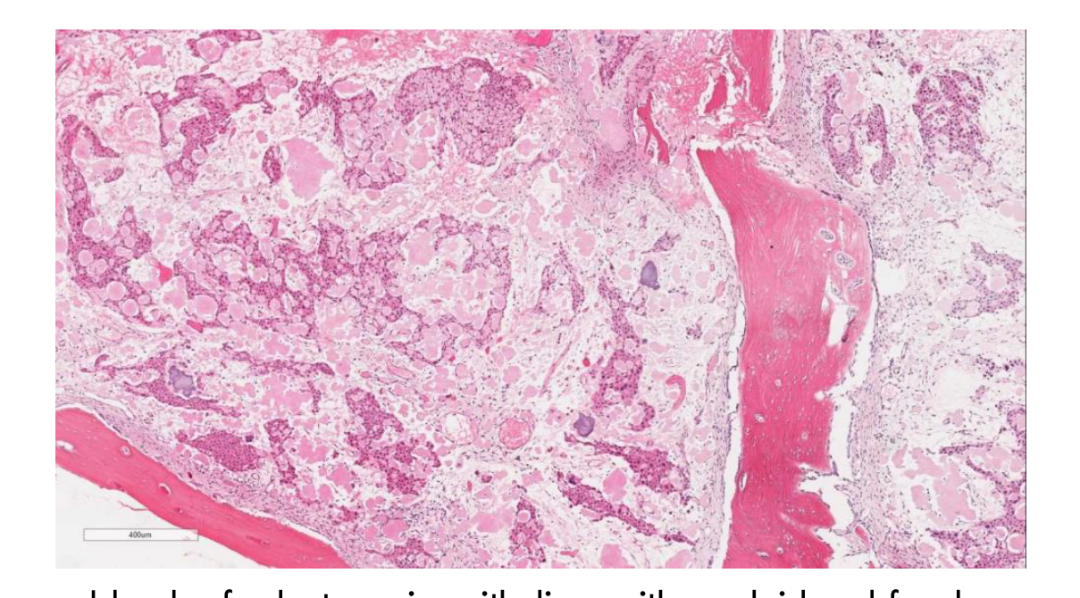 Islands of odontogenic epithelium, with amyloid and focal calcification. (WHO, 2022)