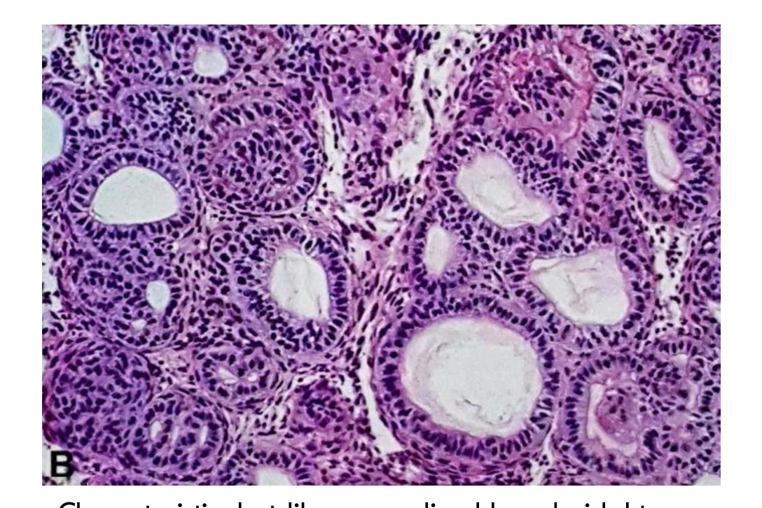 Characteristic duct-like spaces lined by cuboidal to columnar epithelium with nuclei away from the luminal surface. (WHO, 2017)
