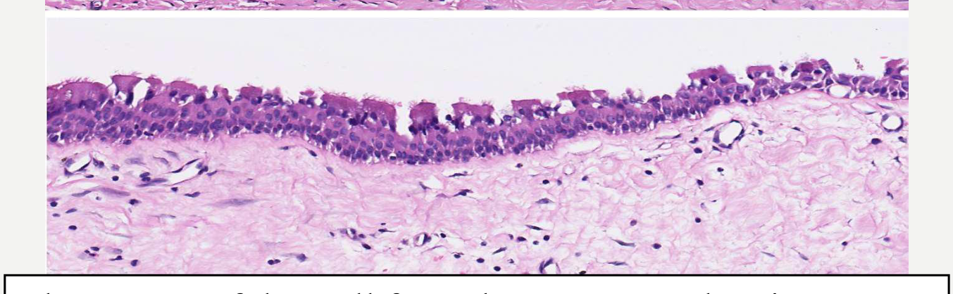 Three areas of the wall from the same cyst showing a range of lining epithelium, from bilaminar cuboidal to low squamous and respiratory, intermediate appearances are often seen. (WHO, 2022)