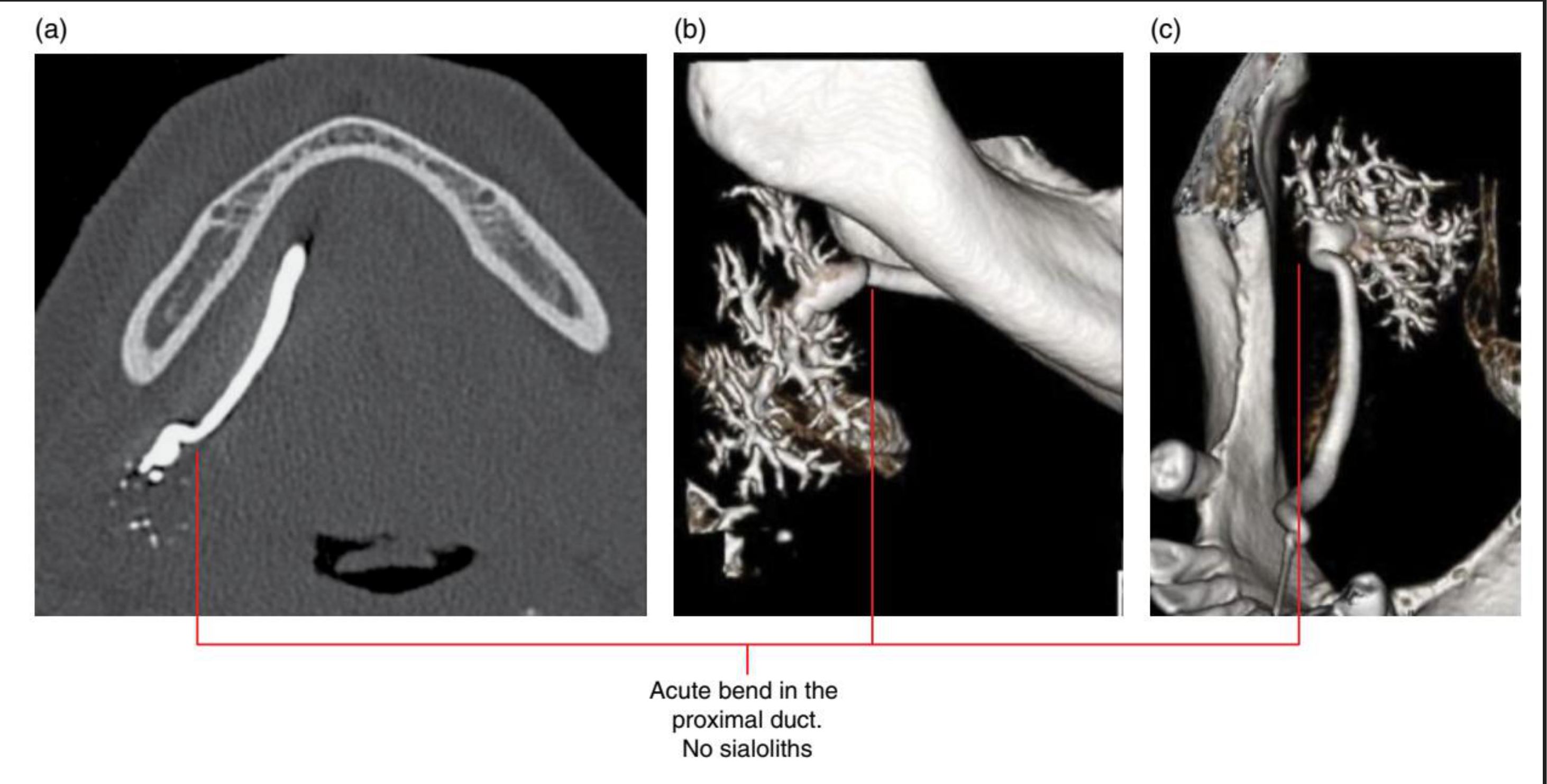 Acute bend in the proximal duct. No sialoliths