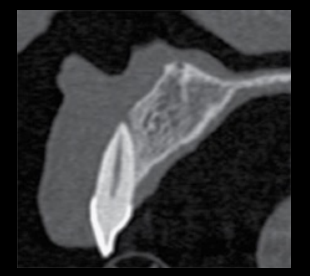 11 on CBCT (sagittal view)