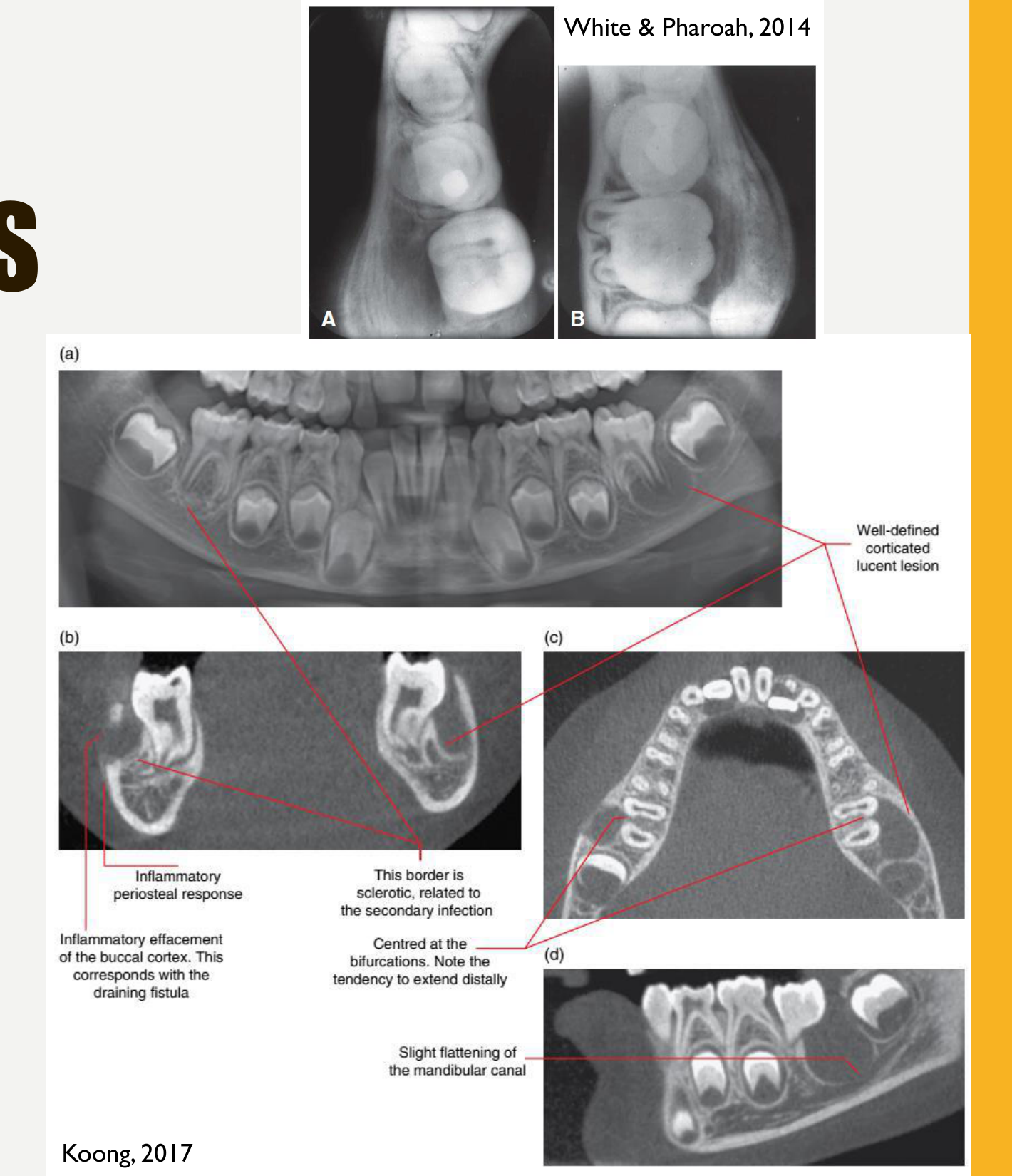 Well-defined corticated lucent lesion Inflammatory periosteal response This border is sclerotic, related to the secondary infection Inflammatory effacement of the buccal cortex. This corresponds with the draining fistula Centred at the bifurcations. Note the tendency to extend distally Slight flattening of the mandibular canal