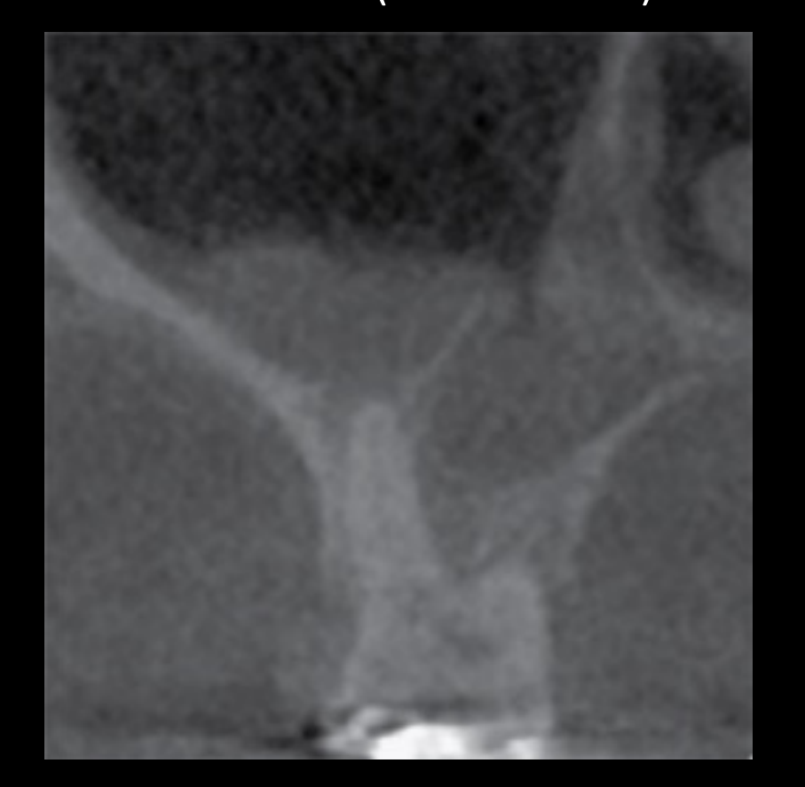 16 on CBCT (coronal view)