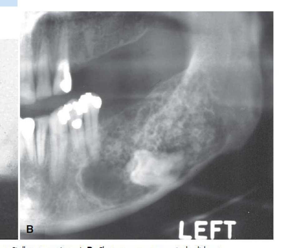 FIGURE 22-19 A, Calcifying odontogenic tumor or Pindborg tumor (arrows). B, The tumor appears as a mixed radiolucent-radiopaque lesion associated with an unerupted tooth. (A, Courtesy M. Gornitsky, DDS, Montreal, Canada. B, Courtesy Dr. D. Lanigan, University of Saskatchewan.)