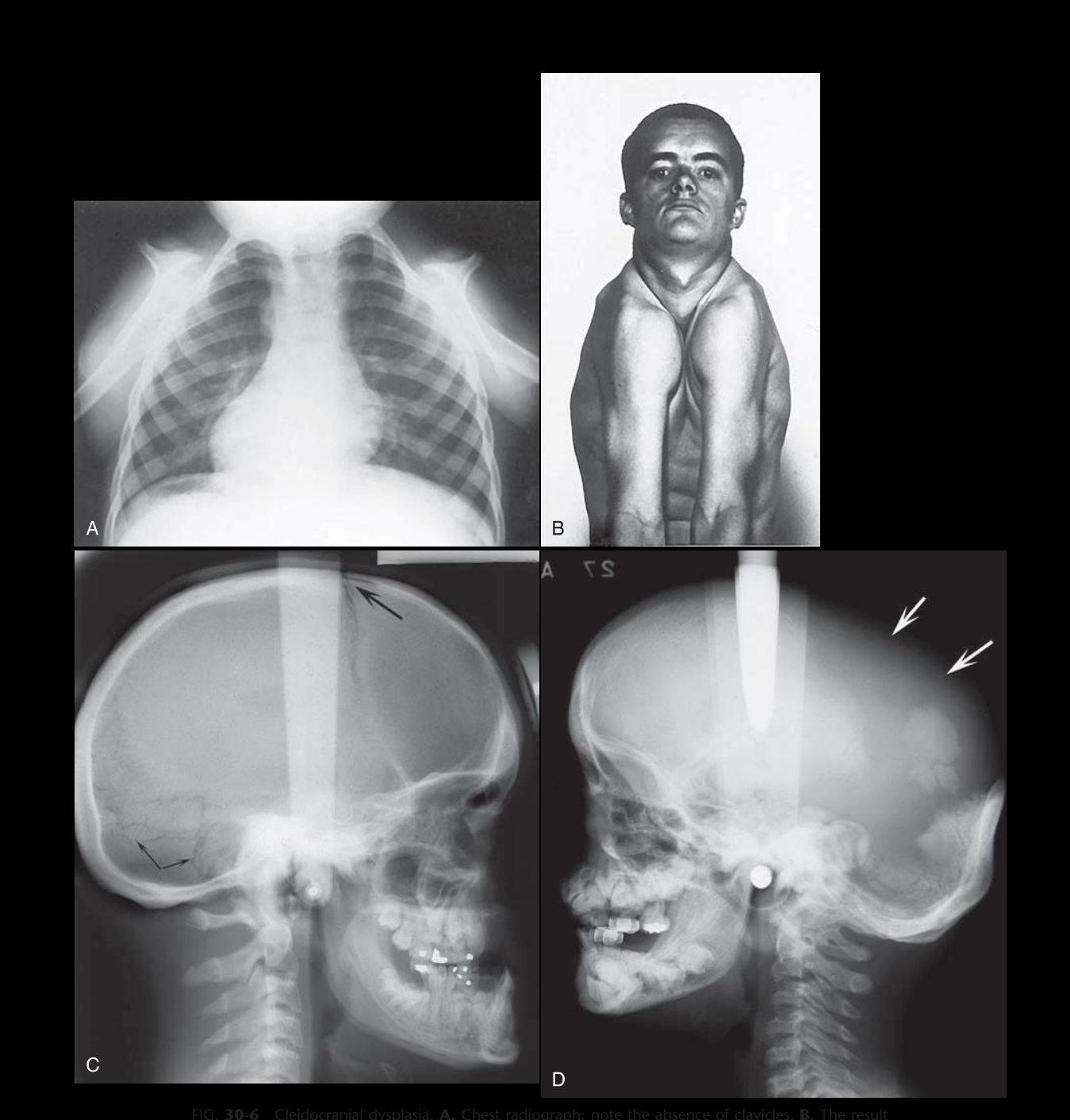 FIG. 30-6 Cleidocranial dysplasia. A, Chest radiograph; note the absence of clavicles. B, The result is excessive mobility of the shoulders. Note also the frontal bossing and underdeveloped maxilla. C, On a lateral radiograph, note the wormian (sutural) bones in the occipital region (arrows) and the open fontanel (large arrow). D, A lateral skull film showing a lack of development of the parietal bones (arrows).