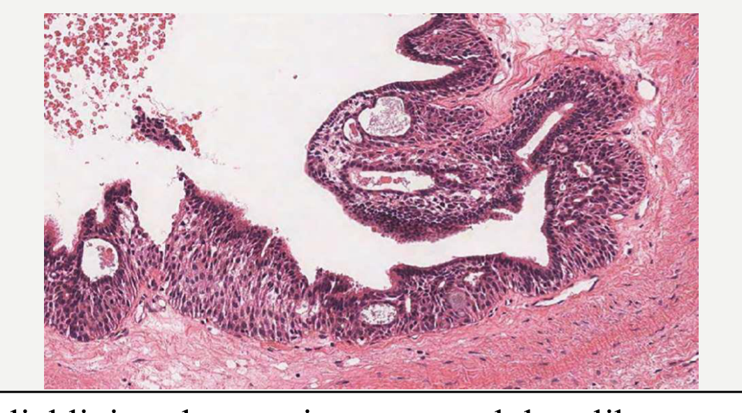 The epithelial lining shows microcysts and duct-like structures. There is a superficial layer of columnar cells, in places with cilia. (WHO, 2022)