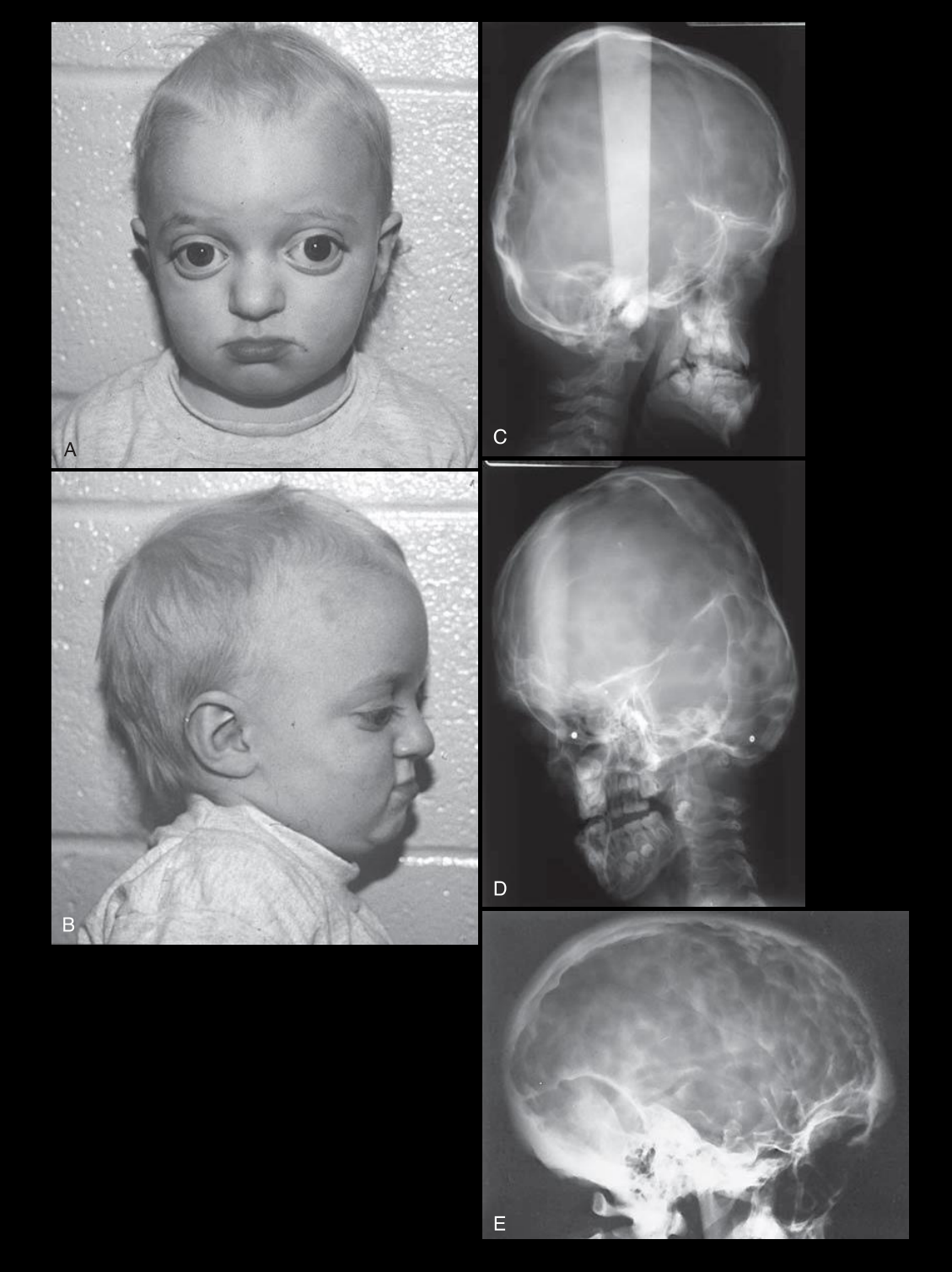 **Crouzon syndrome**