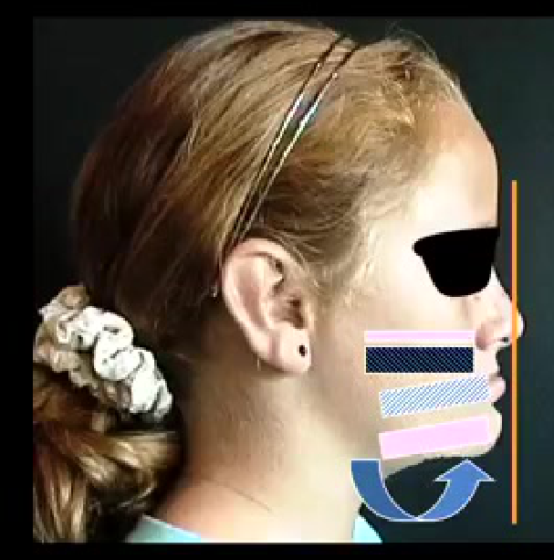Maxilla vertically deficient Mandible rotated up and forward