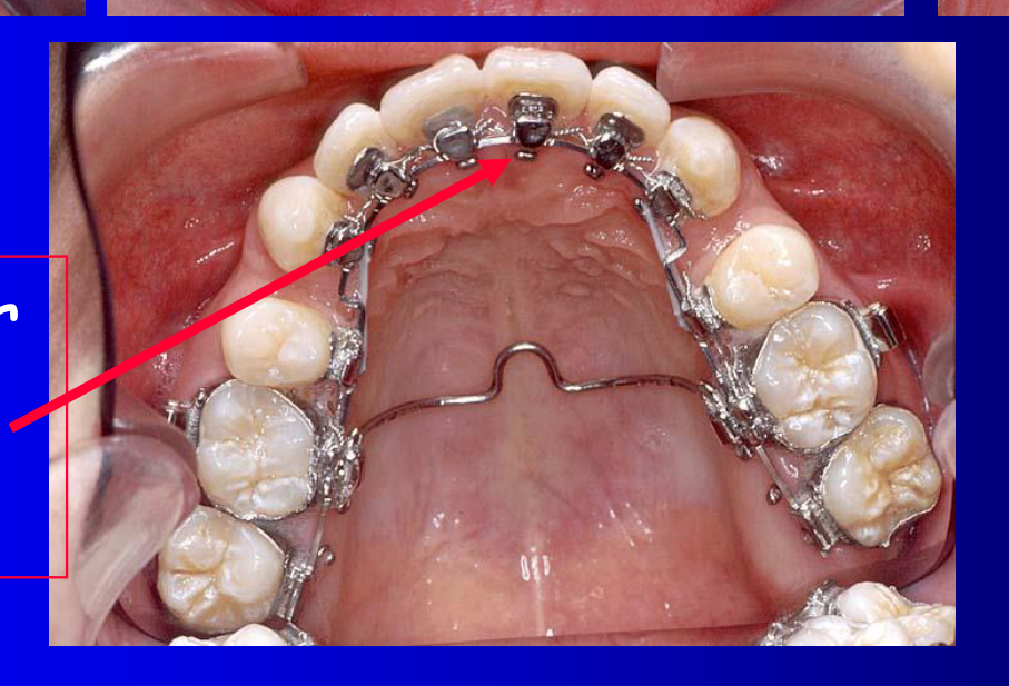 In this case upper bicuspids and anterior teeth