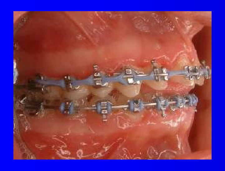 Pre-treatment
