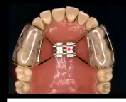 RAPID MAXILLARY EXPANDER