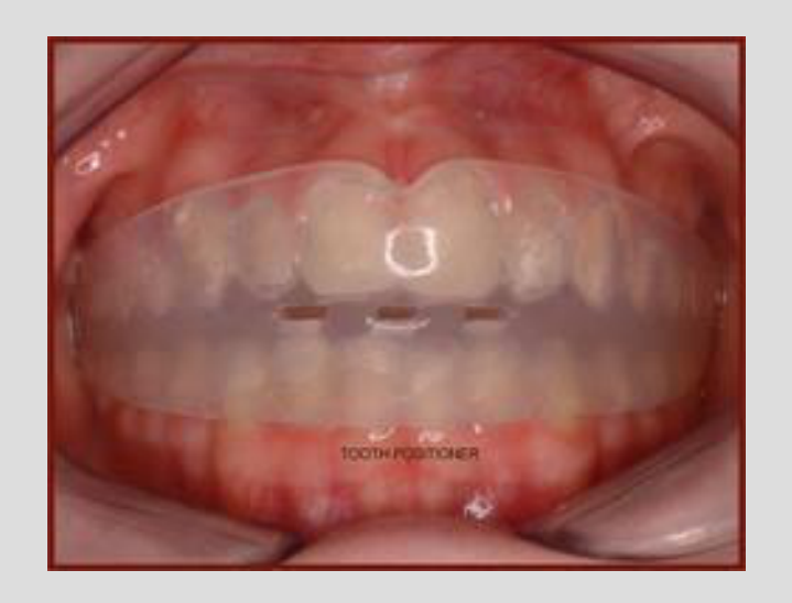 TOOTH POSITIONER