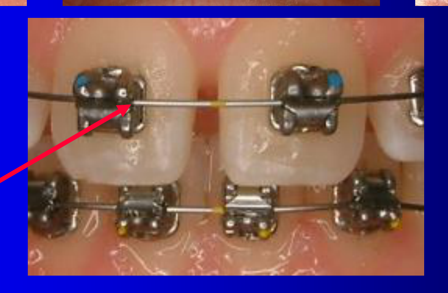 In this case on the bicuspids, canines and incisors