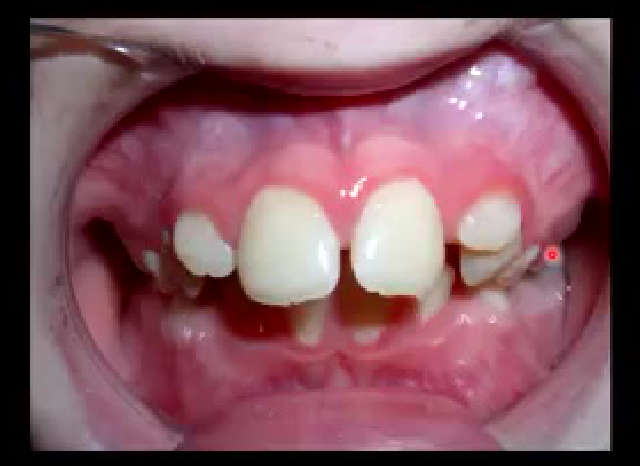 Proclination/Protrusion: overestimate the space available