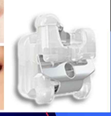 Clear Tooth Colored Ceramic Plastic Lingual Stainless Steel Gold Self-Ligating Stainless Steel combination Ceramic Stainless Steel
