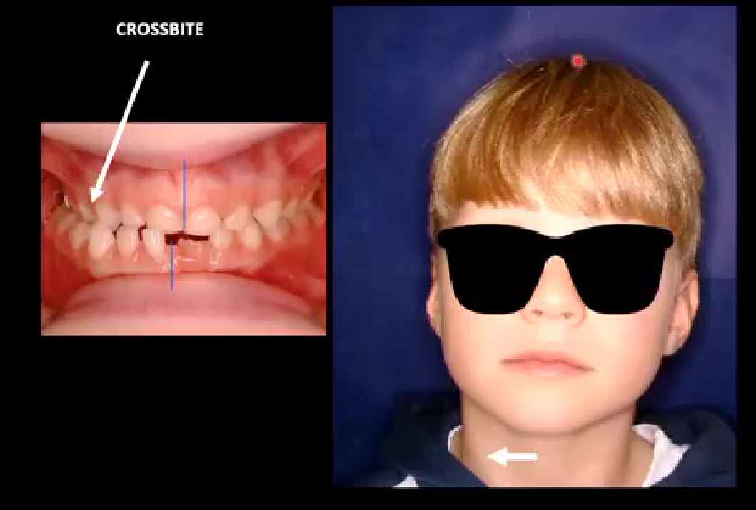 CROSSBITE