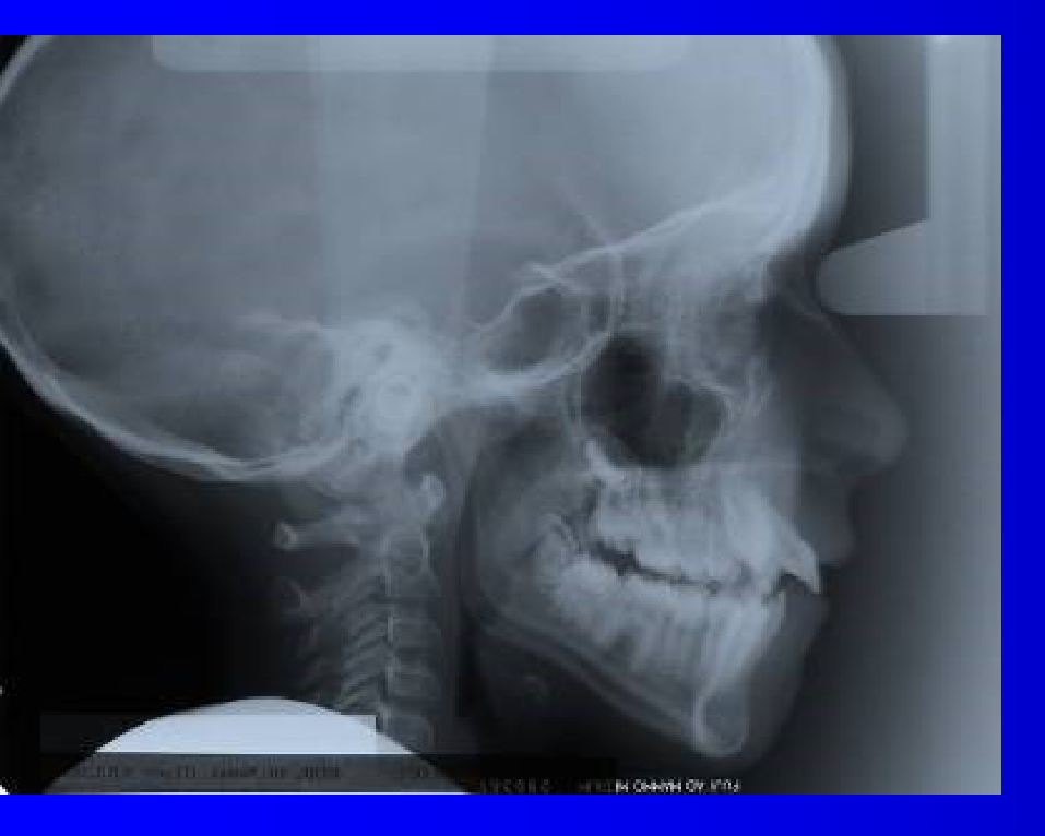Side X-Ray