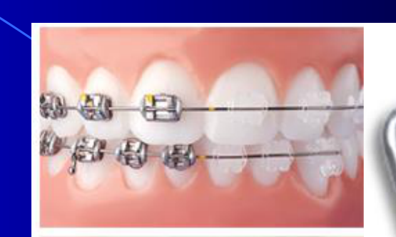 Brackets Metal Stainless Steel