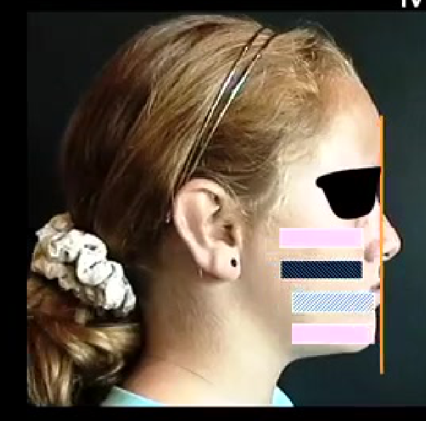 Mandible forward
