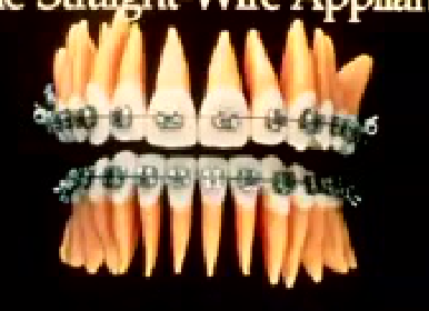 Frontal radiograph of a straight-emgwise appliance, showing the most anterior tilted mesial at the extreme.vertical edge of the base