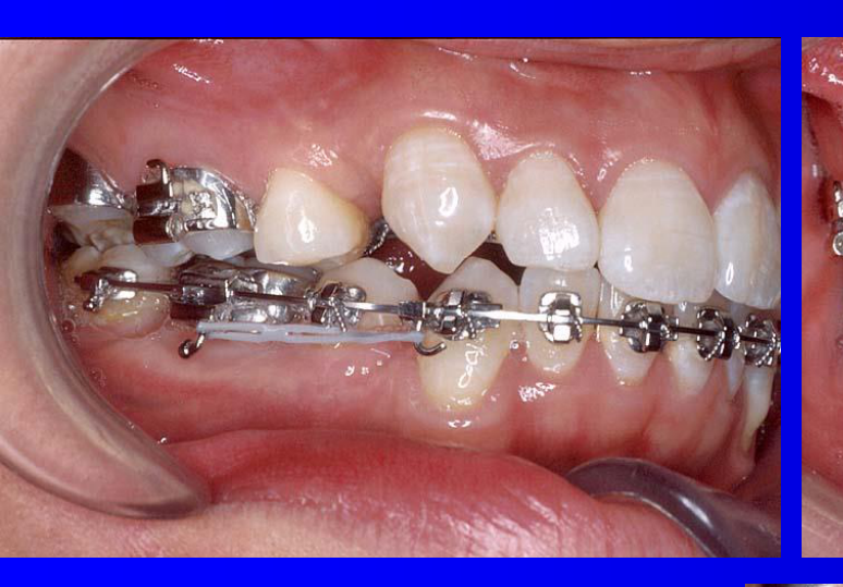 In this case upper bicuspid anterior teeth