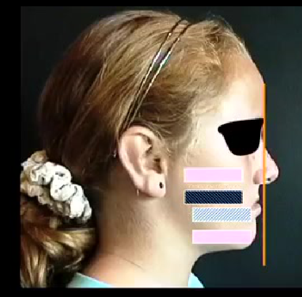 Maxilla back
