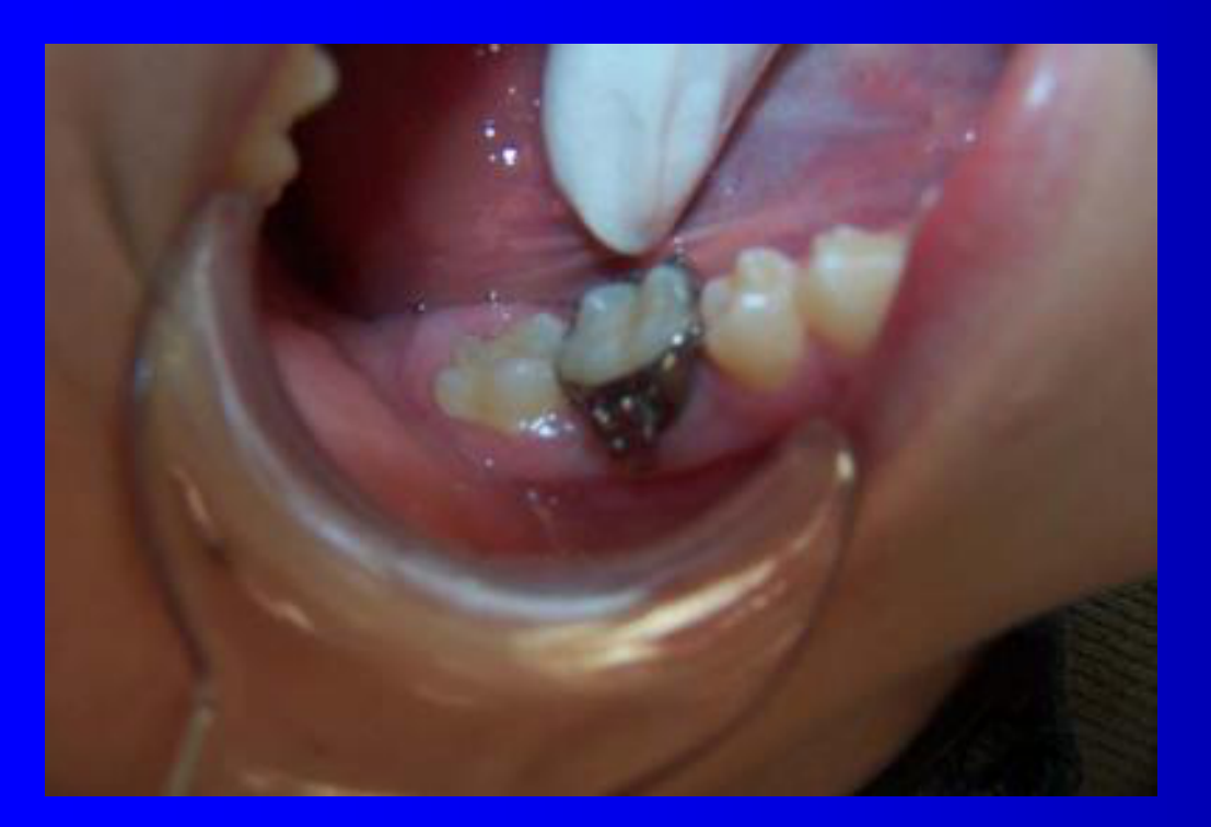 Notice a small gap on the distal lingual cusp