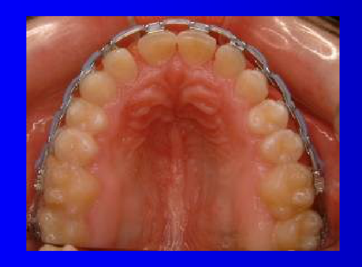 Maxillary arch