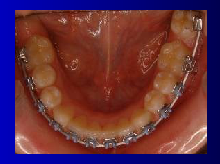 Mandibular arch