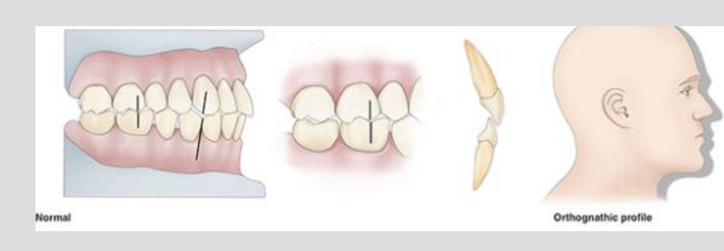 Normal Orthognathic profile