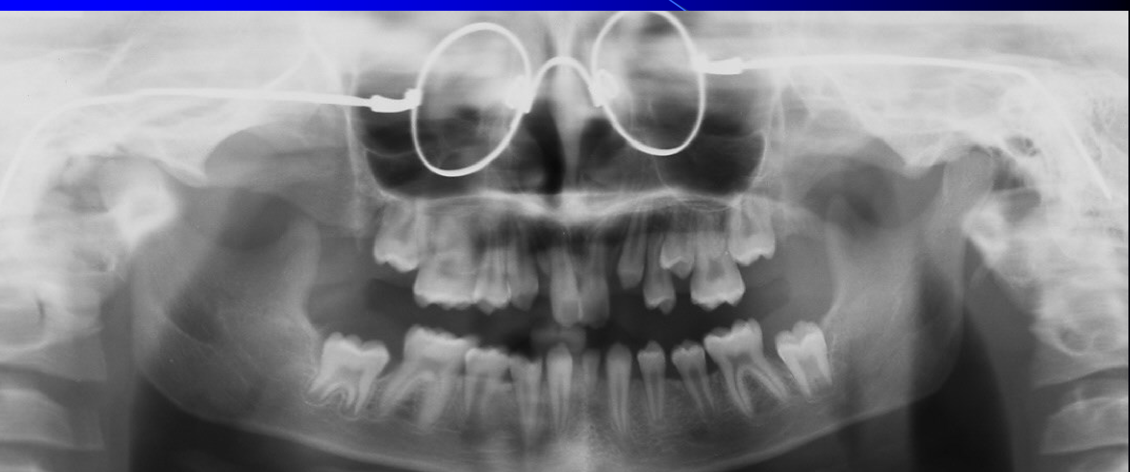 Spontaneous eruption of teeth and space closure to minimize the need for orthodontic or restorative treatment