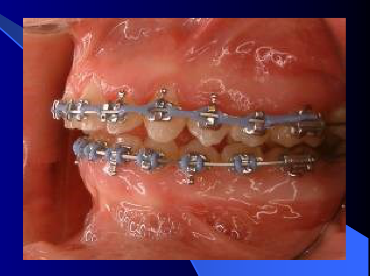 Occlusion