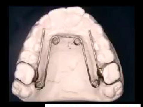 QUAD HELIX and W-ARCH