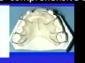 Adam's clasps, labial bow with finger spring