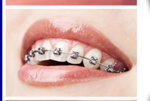 Clear Tooth Colored Ceramic Plastic Lingual Stainless Steel Gold