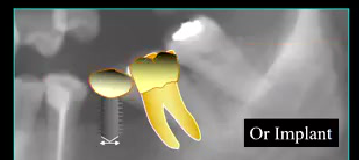 Or Implant