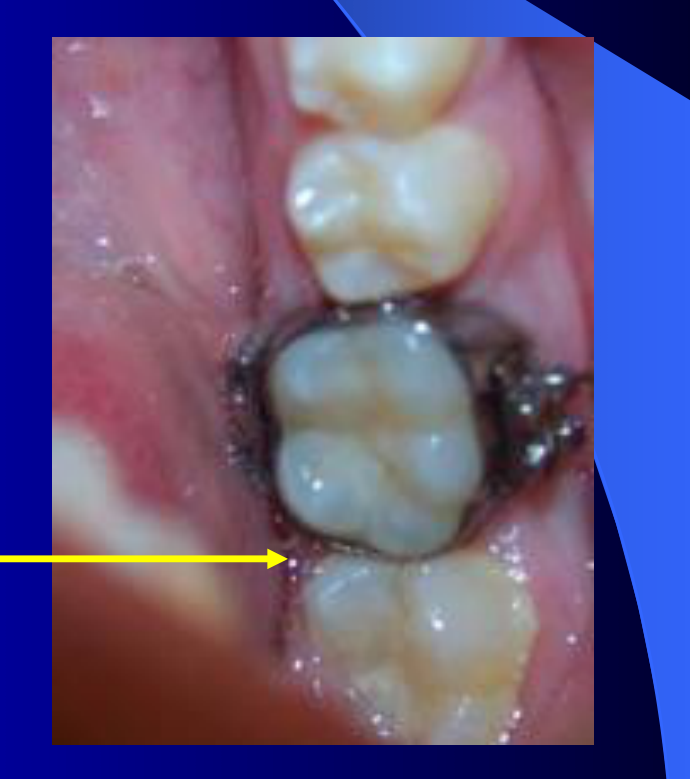 Distal lingual area with band gap on lower first molar