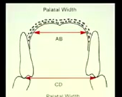 Palatal Width