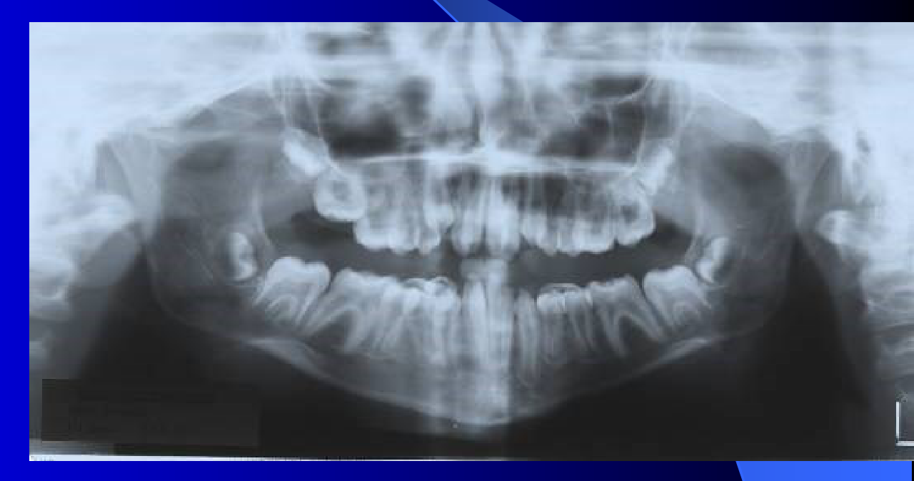 X-Ray