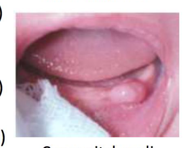 Congenital Epuli