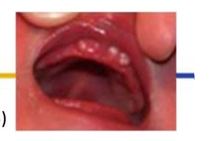 Bohn's nodules