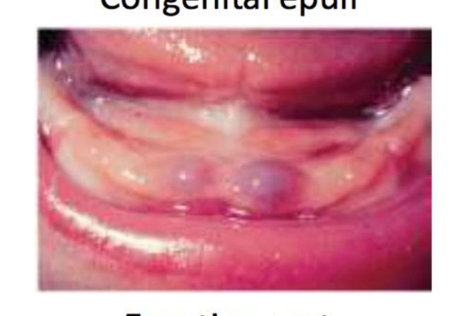 Eruption Cyst