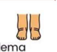 Edema