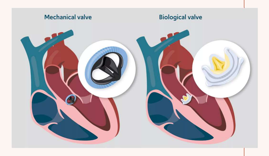 Mechanical valve Biological valve