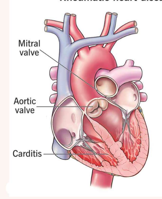 Mitral valve