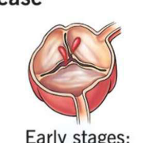 Early stages: regurgitation
